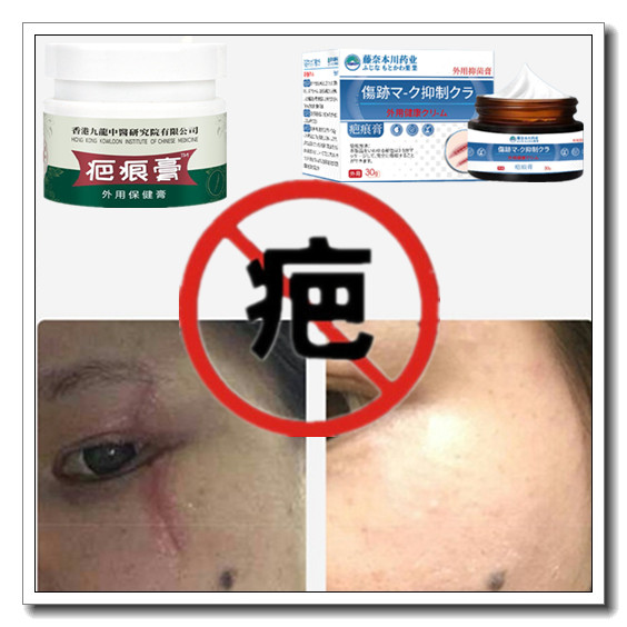 去手术修复增生性体质软化突疤疙瘩破腹产伤疤痕印灵淡化抓痕药膏