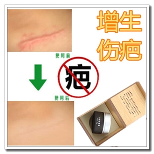 修复去除脸部擦伤摔伤愈合黑色素医院同售剖腹产淡化疤痕护理药膏
