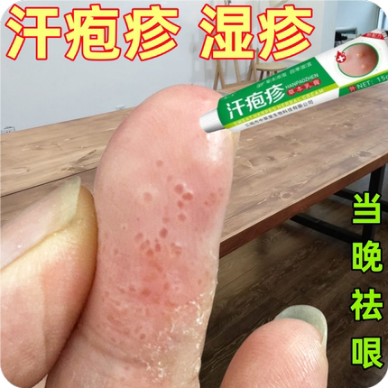 汗泡疱疹药膏手上起小水泡汗状疱疹止痒汉状真菌感染手气专用软膏