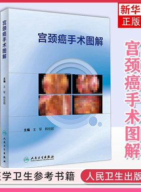 宫颈癌手术图解人卫宫腔镜