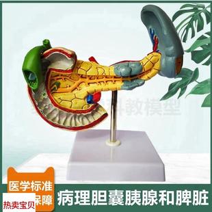 胆囊模型病理胰腺脾脏消化器官十二指肠肝脏N血管肝胆总管临床医