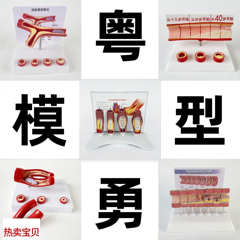 动态血管粘d稠堵塞模型动支脉粥样硬化心血管支架放大病理教学模