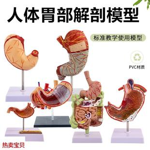 穿孔演示模型 人体胃解剖模型 胃部疾G病胃 胃 病理胃 病变模型