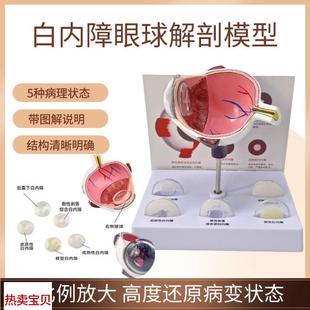 白内障眼球模型病理人体眼球结构眼睛解剖模型医T院学校用教学演
