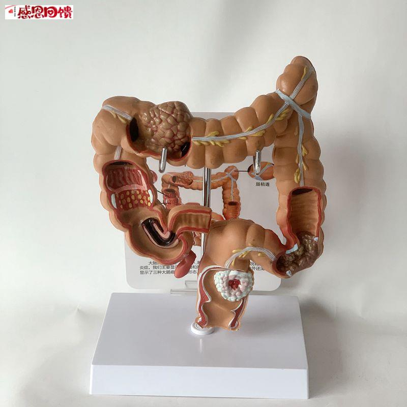 康泰医学模型人体肠道肛管K病理扭转梗阻痉挛大肠医药促销痔疮医