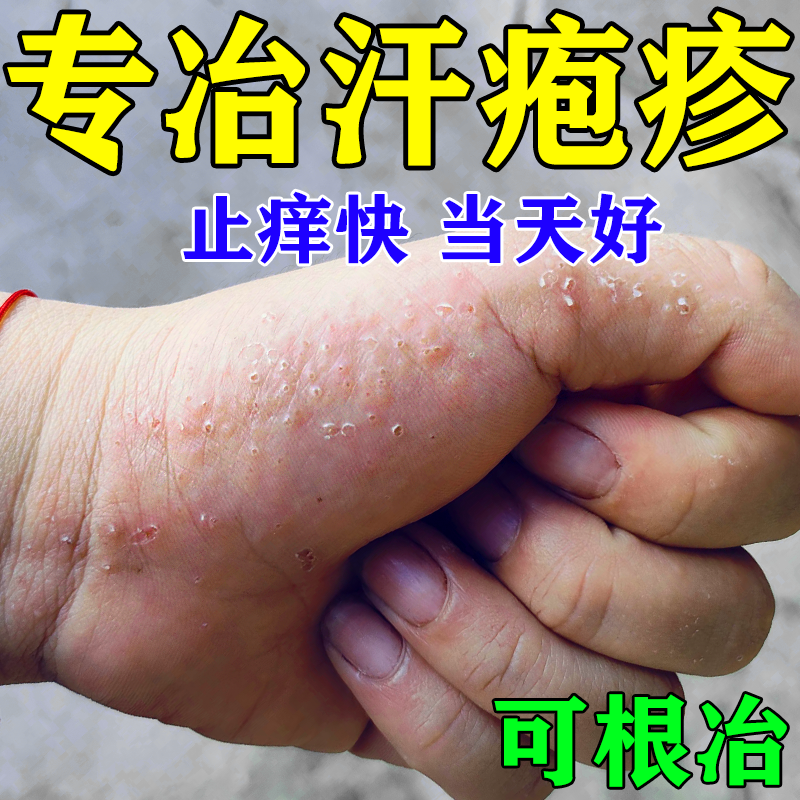 手上起水泡真菌感染状疹疱止痒药手气膏鹅掌风汉状水泡型专用膏药
