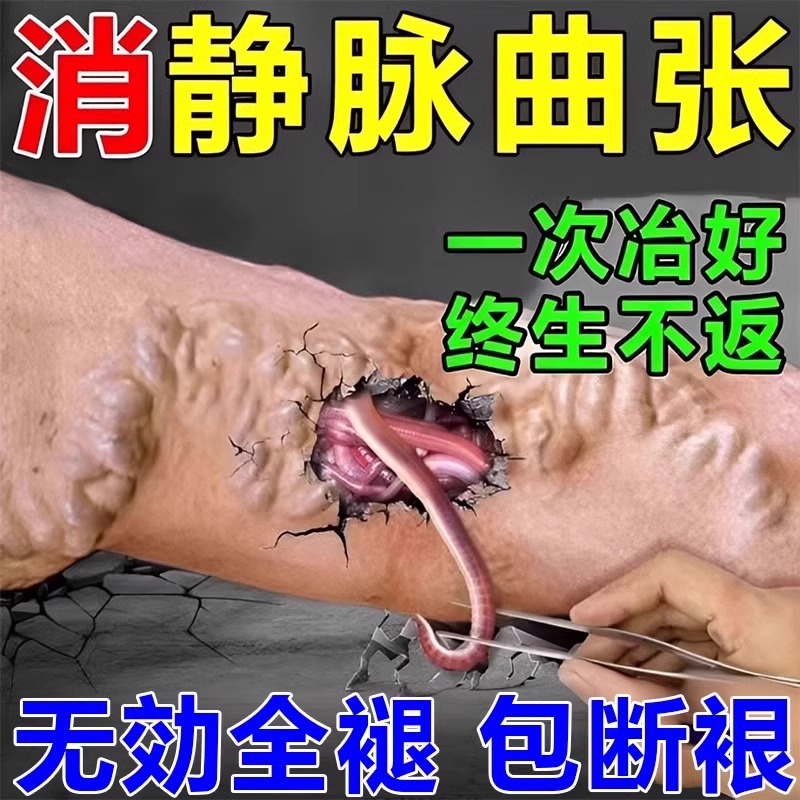 【最慢三天】静脉曲张特效药专用药治疗青筋凸起血管肿胀冷敷贴膏