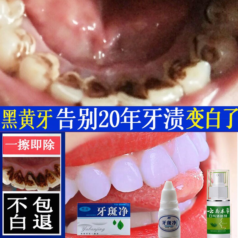 洗牙粉非神器去除牙渍垢膏液口臭男抽烟黑黄牙齿变白洁牙斑净