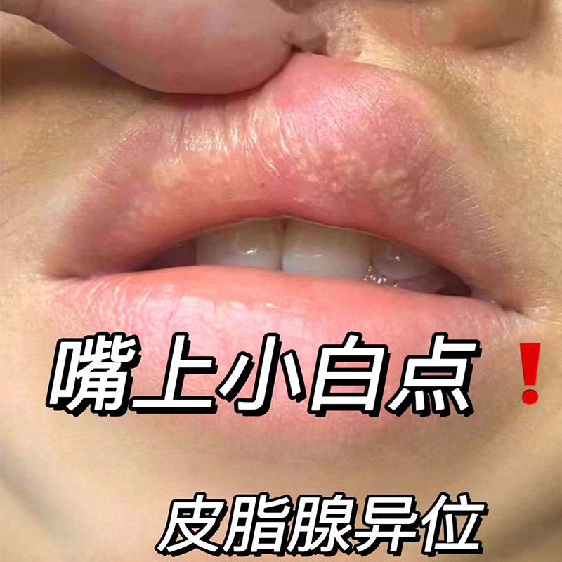 皮脂腺异位症嘴唇白点脂肪小颗粒增生去除唇部干裂脱皮神膏器YU