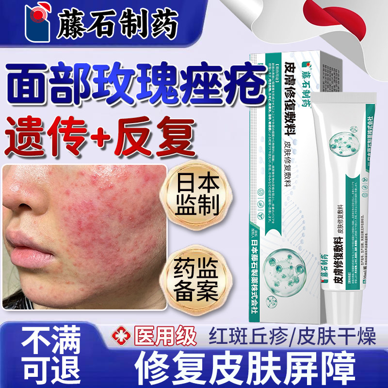 玫瑰痤疮修复屏障敏感肌消软膏炎脂溢性皮炎酒糟鼻搭洗面奶面膜YU,医疗器械,伤口敷料,淘宝优惠券,粉丝福利购,淘宝优惠卷