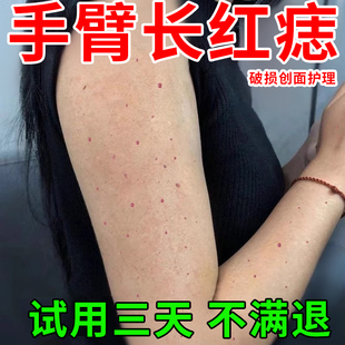 血管瘤血管痣樱桃状胳膊上手臂小红点痣破损创面护理凝胶搭专用YU