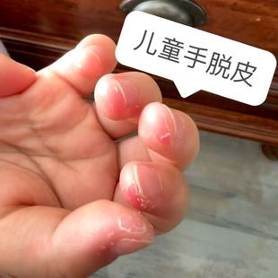 儿童小孩手指尖严重脱皮专用真菌蜕皮干燥起皮剥脱性角质松解症YU