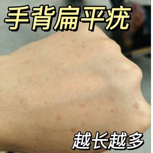 手背扁平疣瘊子软膏医用祛疣瘊丝状疣去小肉粒可搭干扰素b2凝胶YU