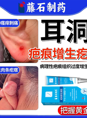 藤石制药耳洞增生疤痕疙瘩凸起硬肉软化针可搭止软化痒乳膏去除ON