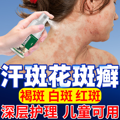 去汗斑花斑癣可搭配专用沐浴露净马拉色菌感染喷剂雾汉斑YU