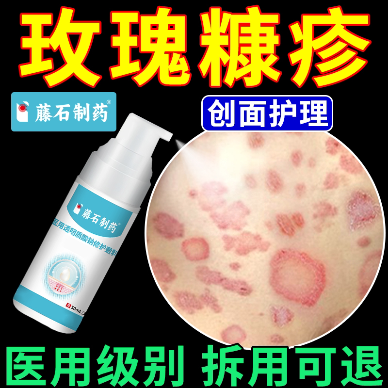 玫瑰糠疹喷雾专用皮肤瘙痒抓破创面护理红斑鳞屑搭沐浴露膏药贴ON