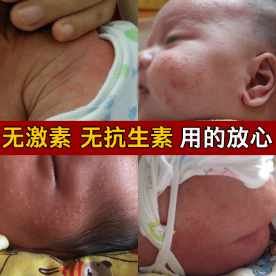 婴儿皮肤瘙痒止痒膏无激素宝宝去痱子红屁屁股湿疹奶藓儿童祛痱霜