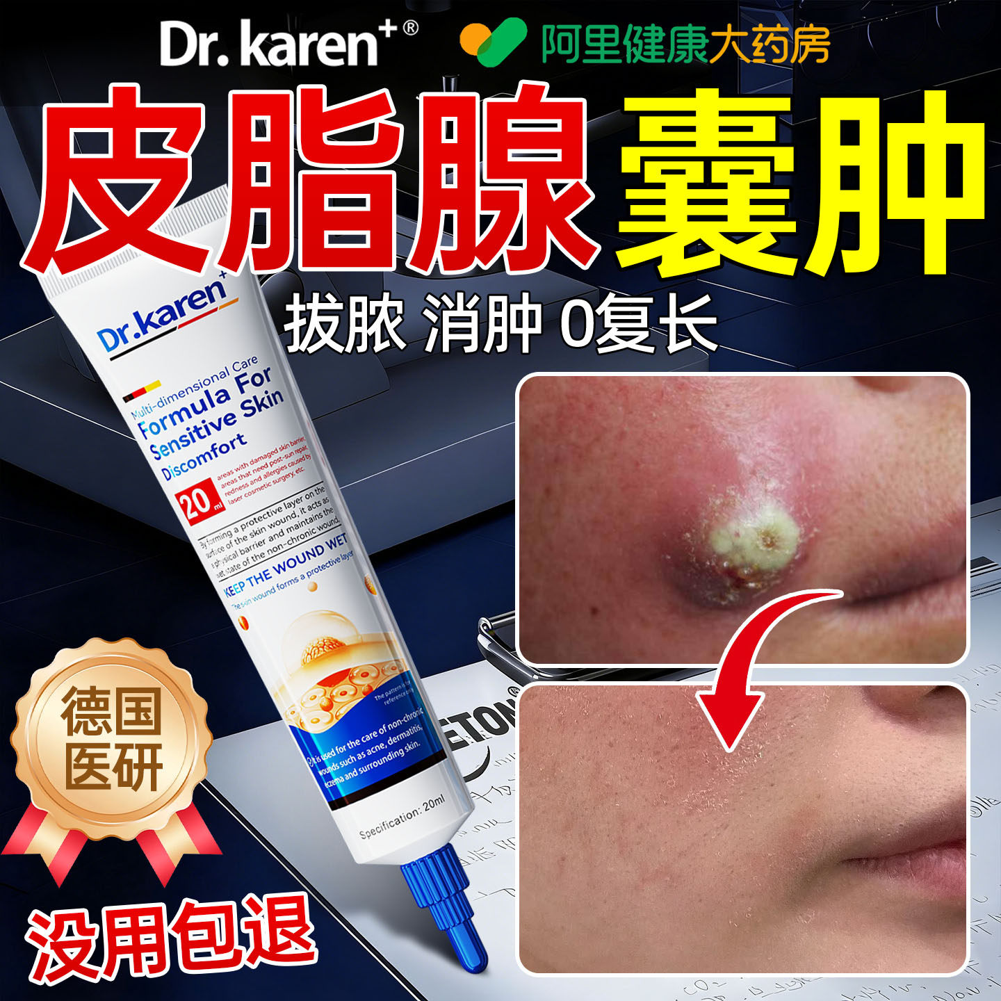 粉瘤皮脂腺囊肿专用膏拔毒去除火疖子纤维瘤消瘤耳后皮下硬块药房
