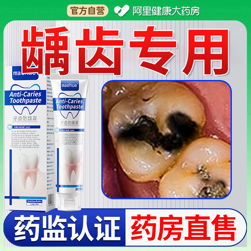 龋齿专用修复防蛀牙儿童成人含氟膏抗敏修补医用型官方正品牙齿