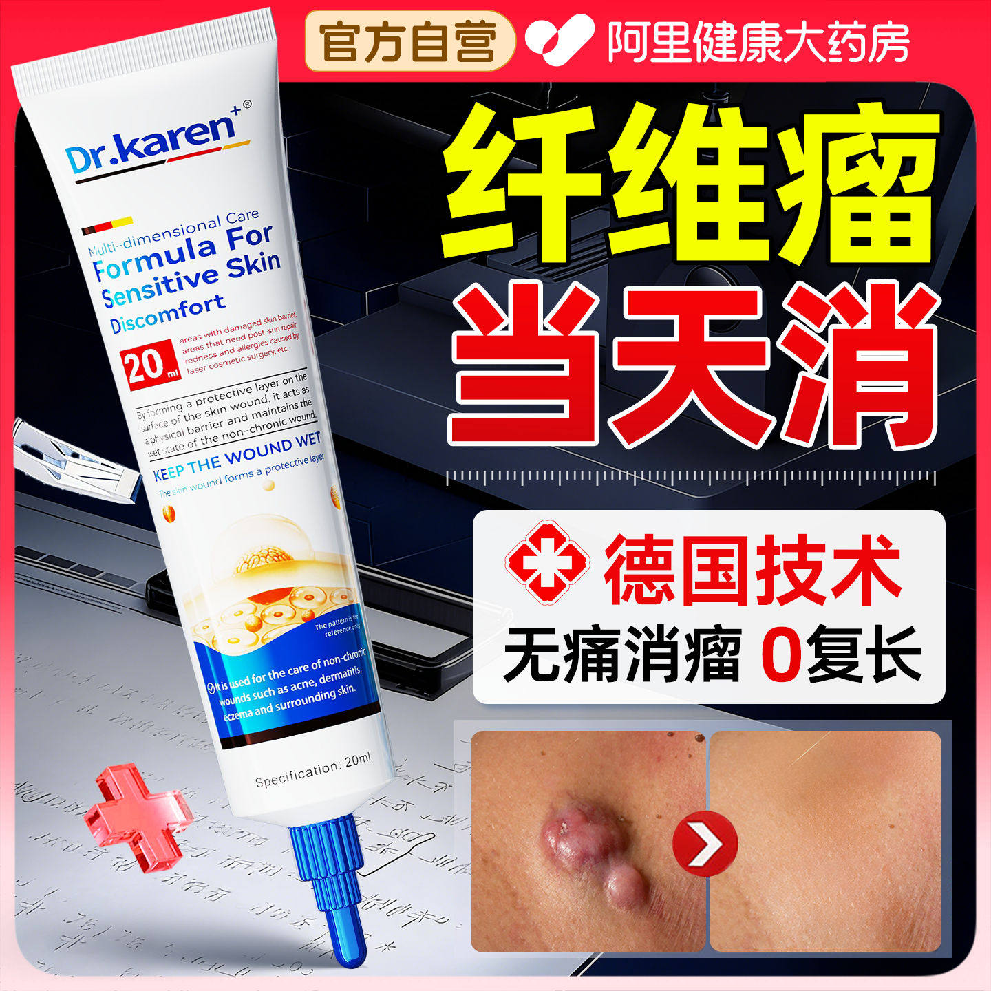 皮肤纤维瘤去除药膏皮下肿硬块肉粒疙瘩结节囊肿消脂肪粉瘤神经器