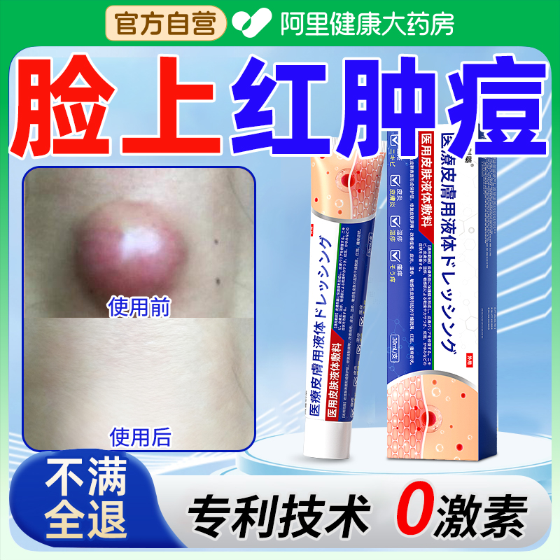 长痘痘起小疙瘩鼻子脓包型挤脓包神器