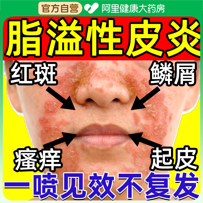 脂溢性皮炎面部泛发红鼻翼鼻子两侧干燥脱皮头皮屑真菌感染非软膏