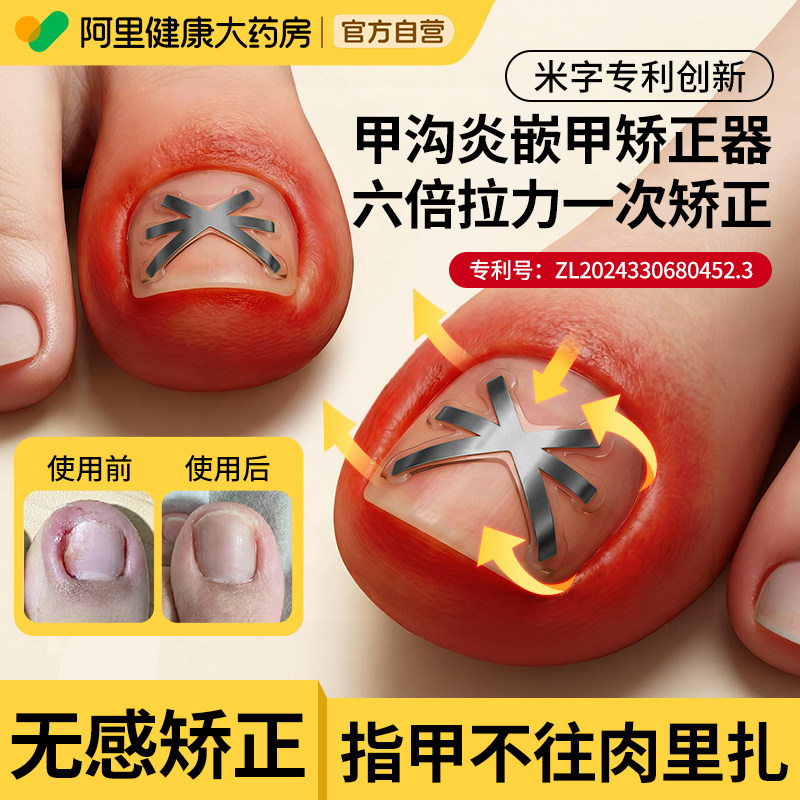 甲沟矫正器炎正甲贴嵌甲贴片脚趾指甲往肉里长纠正专用贴男女通用