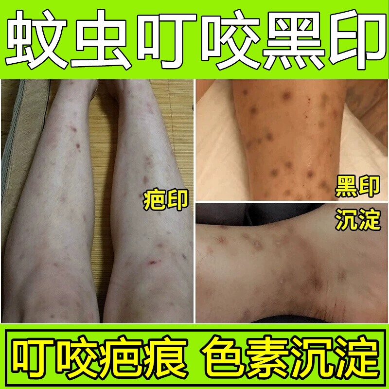 蚊虫叮咬祛疤膏疤痕去黑印黑色素沉淀蚊子跳蚤咬的印儿童修复凝胶图片