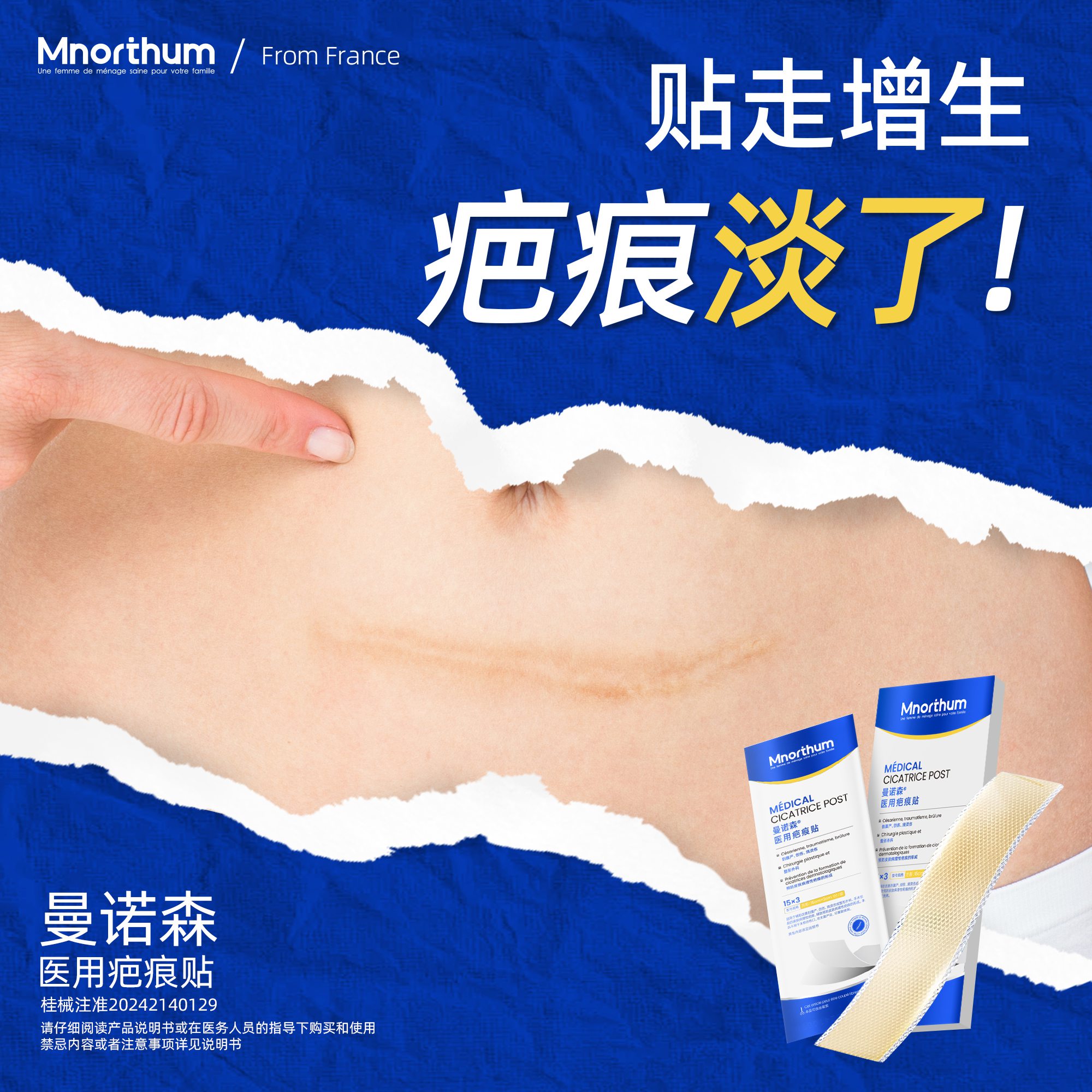 医用疤痕贴剖腹产硅酮凝胶敷料除疤膏妊娠产品祛疤儿童小孩