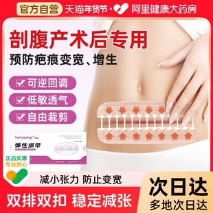 医用减张器剖腹产减张贴术后伤口愈合拉链式免缝疤痕减张可逆回调