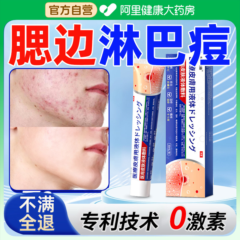 淋巴痘腮边痘下巴脖子反复长痘痘硬块痤疮上脸颊两边结节玫瑰痤疮