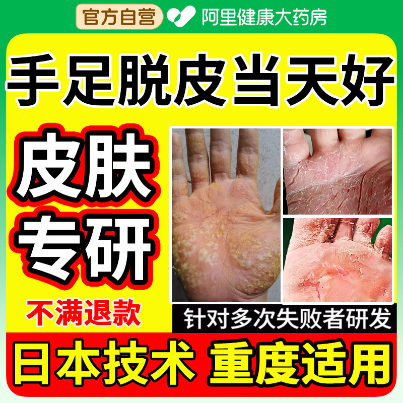 手脱皮专用药膏真菌蜕皮干燥起皮专用治儿童手指上手足脱皮掉干裂
