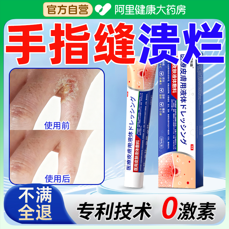 手指缝溃烂止痒脱皮水泡手气糜烂瘙痒手癣膏真菌感染烂手丫间药膏