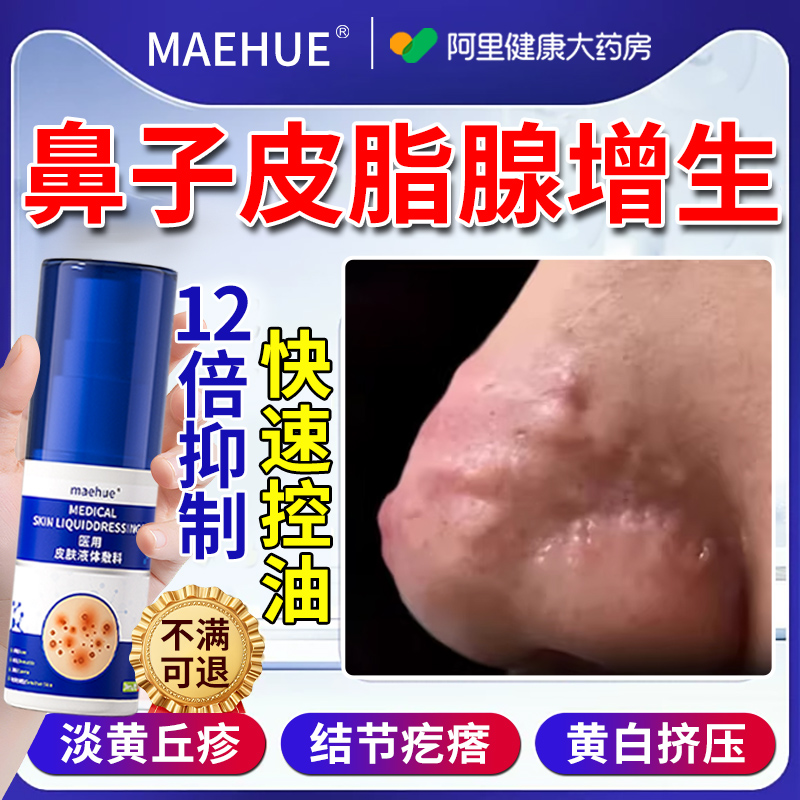 【临床医研】皮脂腺增生不反复