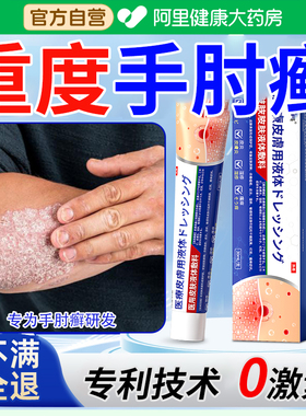 手肘癣手臂胳膊肘肚皮后背顽固性皮癣过敏神经性皮炎搭止痒膏