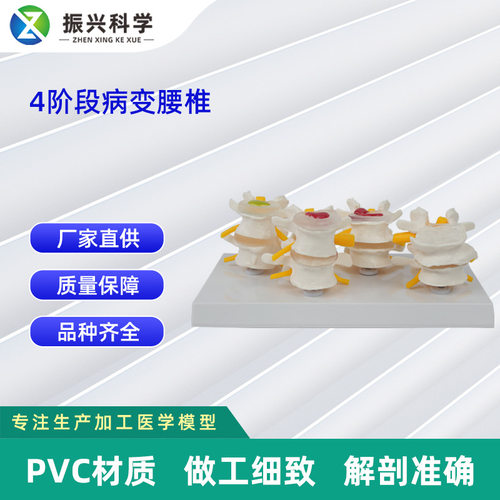 4阶段病态腰椎比较模型  人体骨骼模型教学模型厂家供应