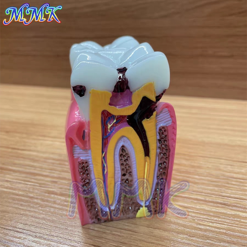 6倍大龋齿牙模型对比牙模型摆件牙齿病理模型蛀牙模型沟通讲解用