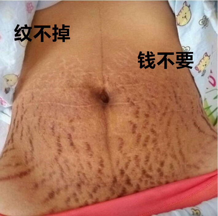 肚皮纹去掉 壬辰花肚皮