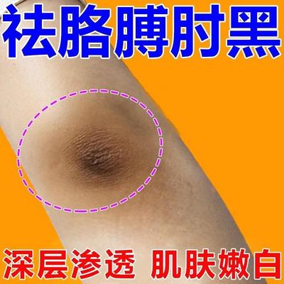 胳膊肘去黑皮肤膏黑色素沉淀去除死皮角质手肘膝关节神器贴净化素