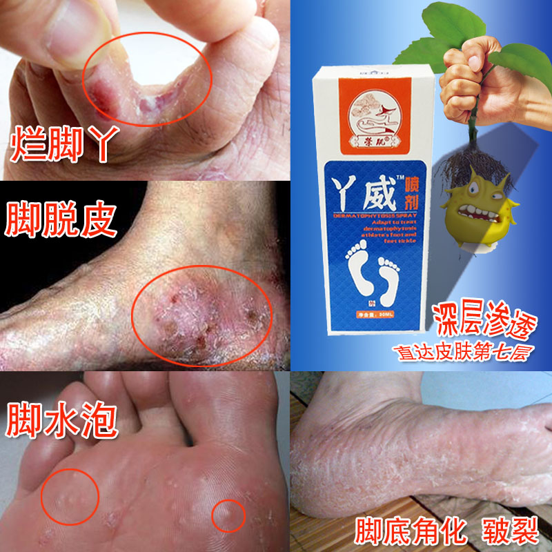 荣肌丫威喷剂脚痒水泡脱皮烂脚丫杀菌止痒去脚臭粉脚汗糜烂水泡型