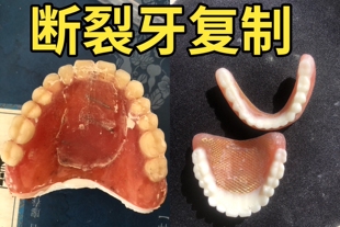 断裂牙 复制 断裂牙修复 假牙复制 假牙修复