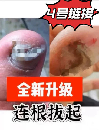 灰-指-甲增厚空甲甲萎缩指甲凹凸变黄甲浑浊甲克奇