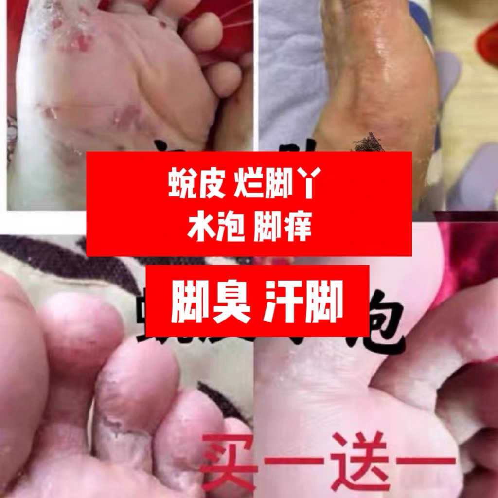 脚痒水泡烂脚丫水泡蜕皮脚后跟干裂脚臭拍我完善
