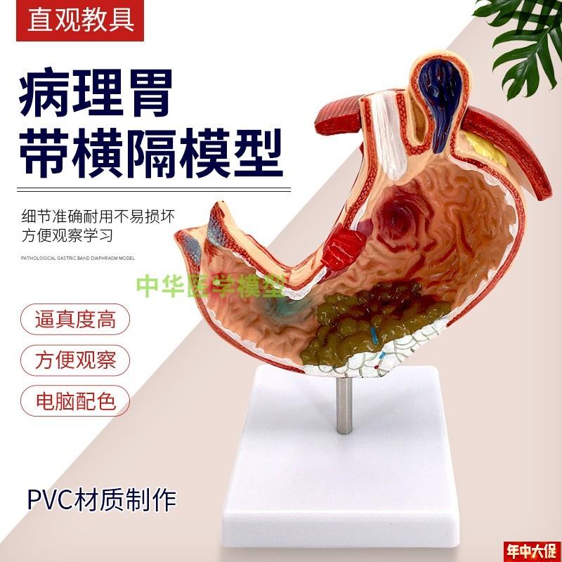 胃及剖面模型病态胃解剖胃模型病理胃结构模U型胃壁消化系统
