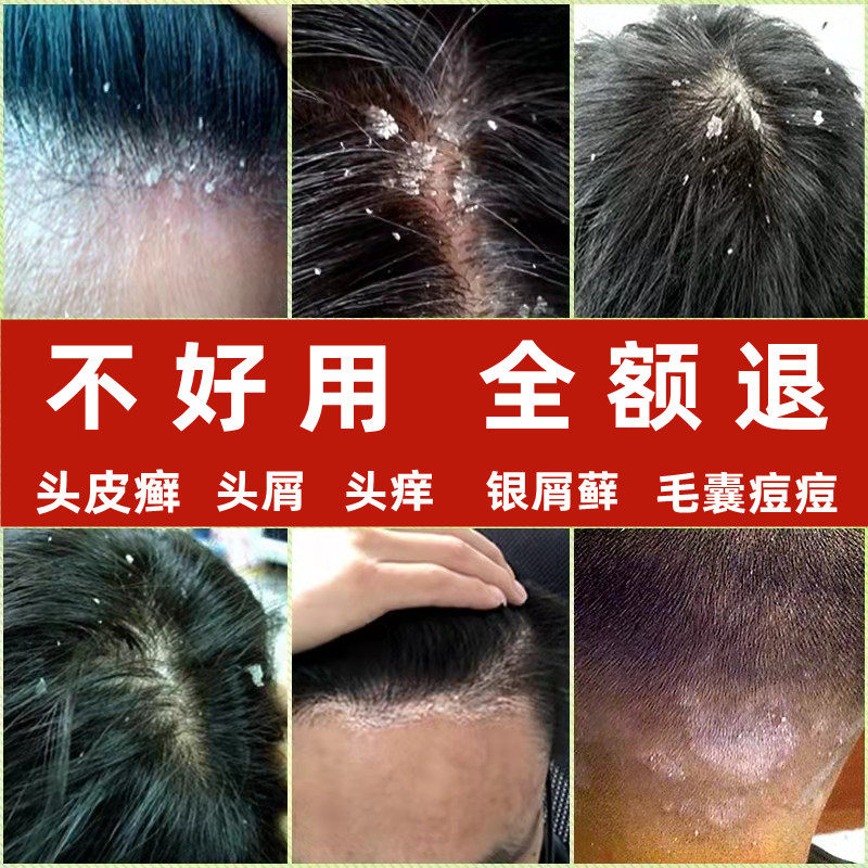 头皮藓洗头水修复抗菌去头皮屑癣清洁油去屑止痒头上长痘痘非康王