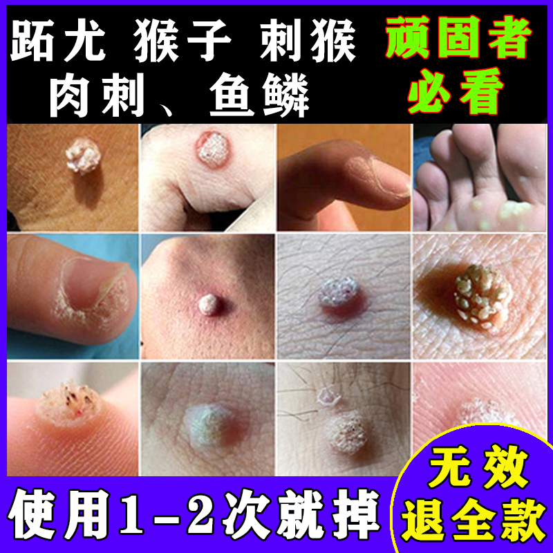 正品去猴子小肉粒肉粒手部疙瘩