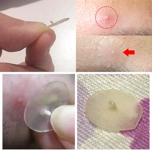 Acne Pimple Patch Stickers Treatment Pimple Remover 痘痘贴
