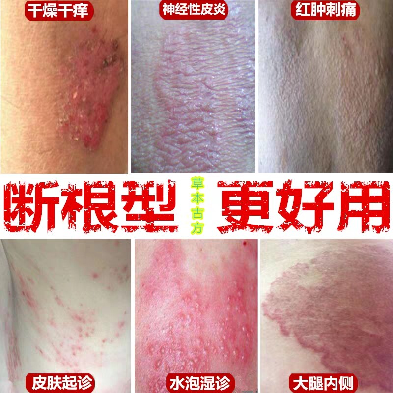 手癣外用真菌感染牛皮癣汗疱疹股藓药膏银屑特效神经性皮炎去根除在类目 本地化生活服务, 健康服务, 预约就医, 健康咨询中 - 来自Buy2taobao.com提供专业的淘宝代购服务