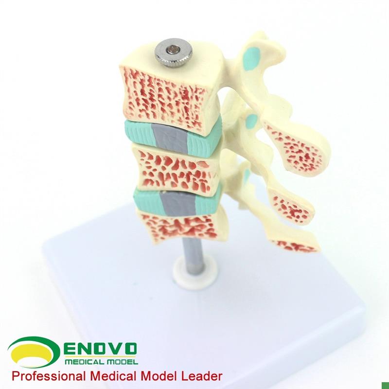 ENOVO颐诺人体骨质疏松症模型关节骨质疏松模型人V体椎间盘腰椎模