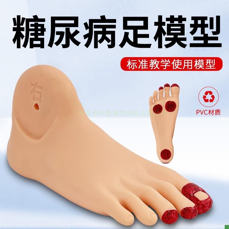 糖尿bing足护理模型老x年人足部病变护理模型畸形脚模具